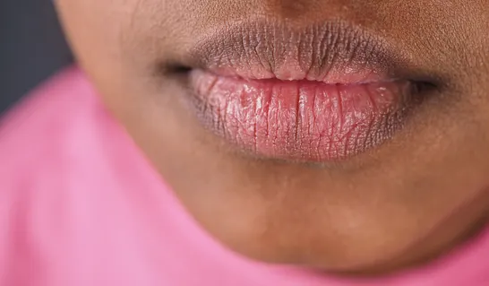 Understanding Dark Lip Pigmentation: Causes and Advanced Clinical Treatments